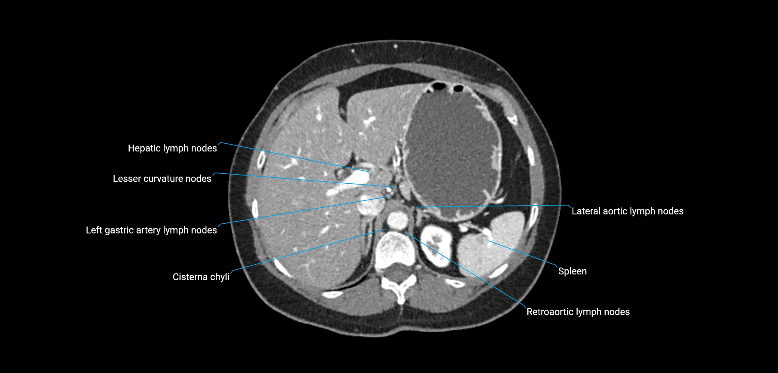 CT ct abdominal lymph nodes  axial cross sectional anatomy  enchanced radiology image -img-00002-00129.webp
